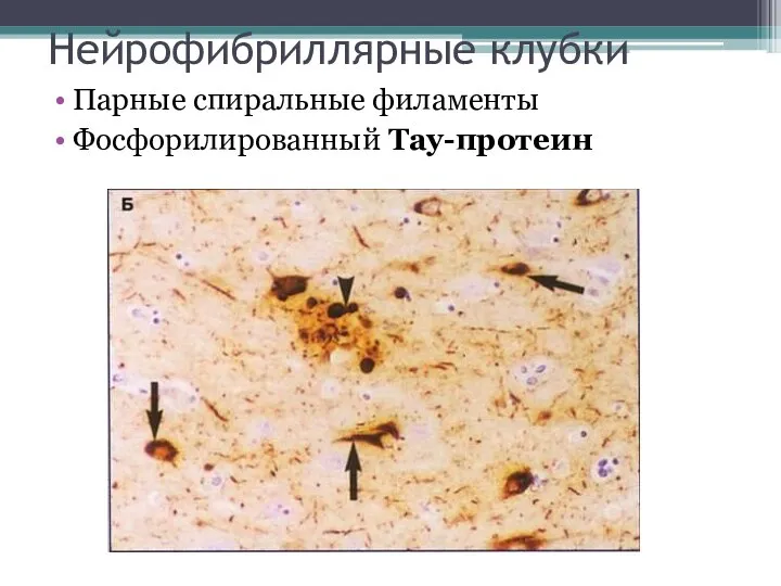 Нейрофибриллярные клубки Парные спиральные филаменты Фосфорилированный Тау-протеин