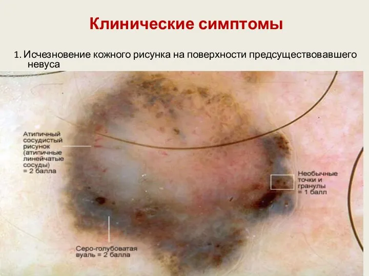 Клинические симптомы 1. Исчезновение кожного рисунка на поверхности предсуществовавшего невуса