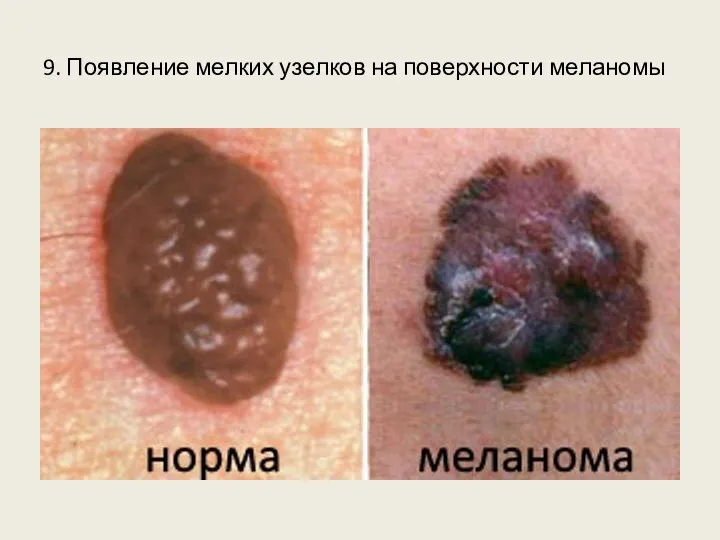 9. Появление мелких узелков на поверхности меланомы