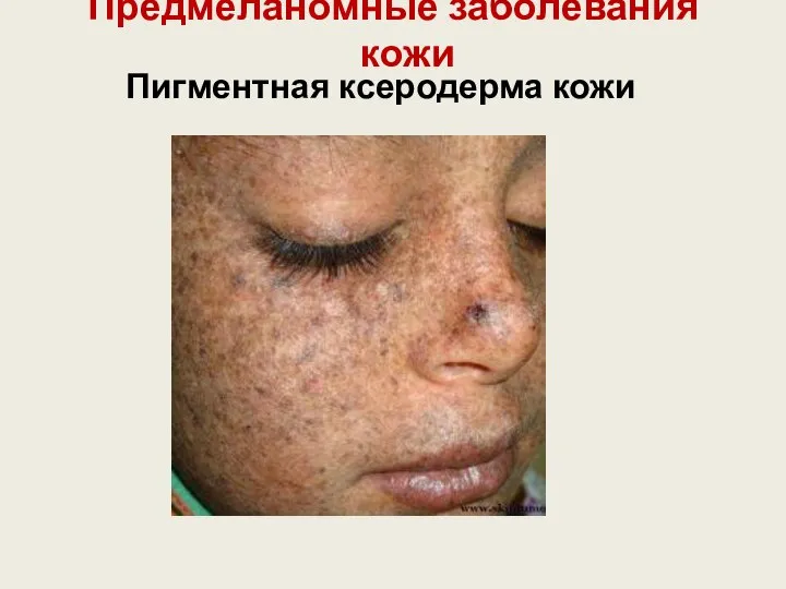 Предмеланомные заболевания кожи Пигментная ксеродерма кожи