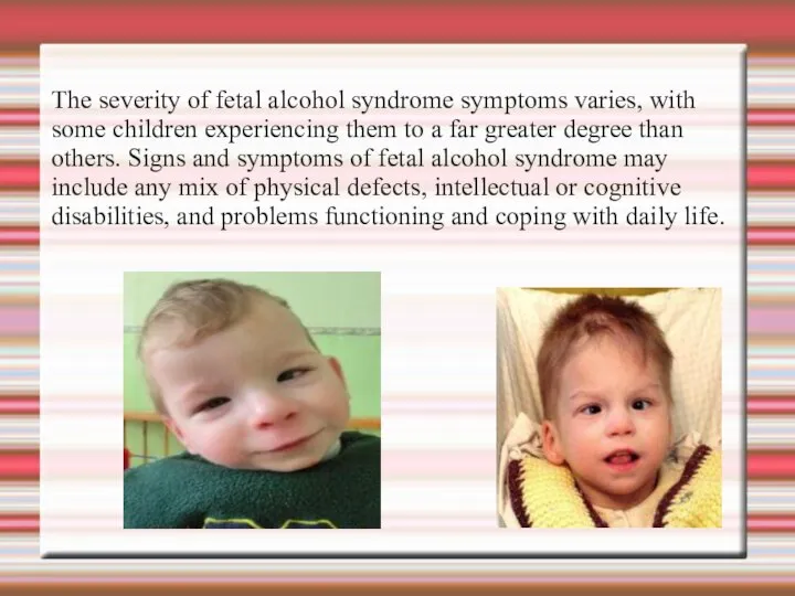 The severity of fetal alcohol syndrome symptoms varies, with some children experiencing