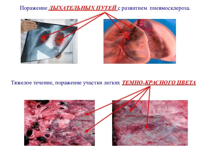 Поражение ДЫХАТЕЛЬНЫХ ПУТЕЙ с развитием пневмосклероза. Тяжелое течение, поражение участки легких ТЕМНО-КРАСНОГО ЦВЕТА