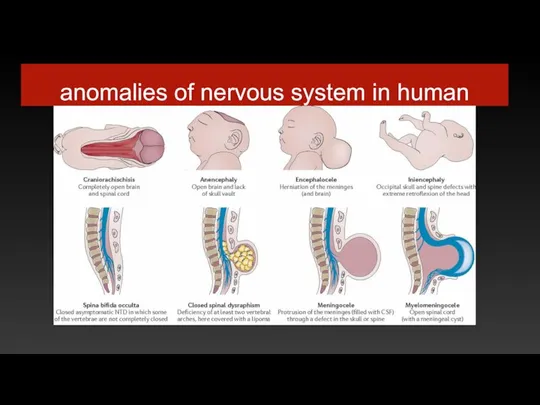 anomalies of nervous system in human
