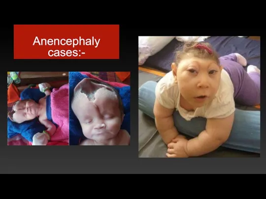 Anencephaly cases:-
