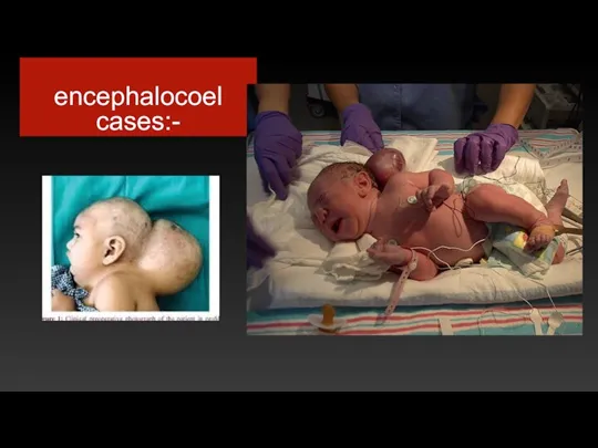 encephalocoel cases:-