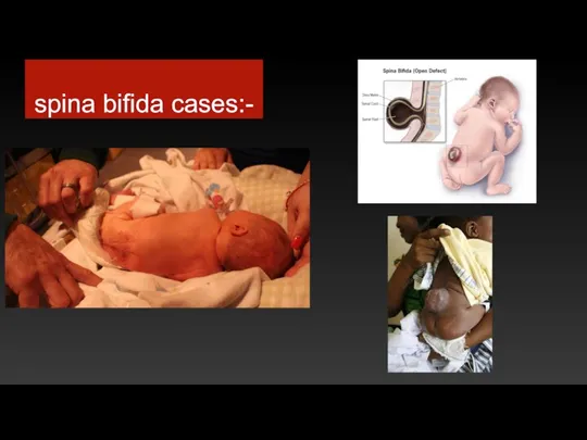 spina bifida cases:-