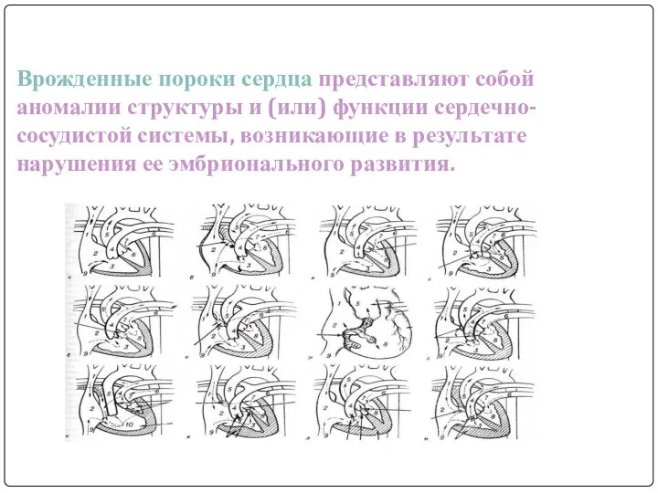 Врожденные пороки сердца представляют собой аномалии структуры и (или) функции сердечно-сосудистой системы,