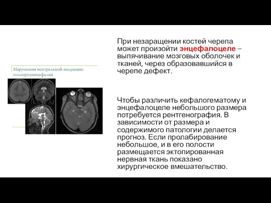 При незаращении костей черепа может произойти энцефалоцеле – выпячивание мозговых оболочек и