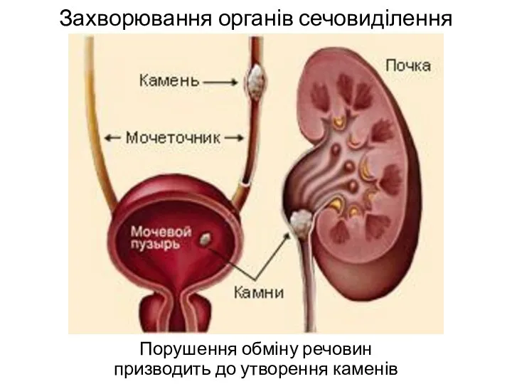 Захворювання органів сечовиділення Порушення обміну речовин призводить до утворення каменів