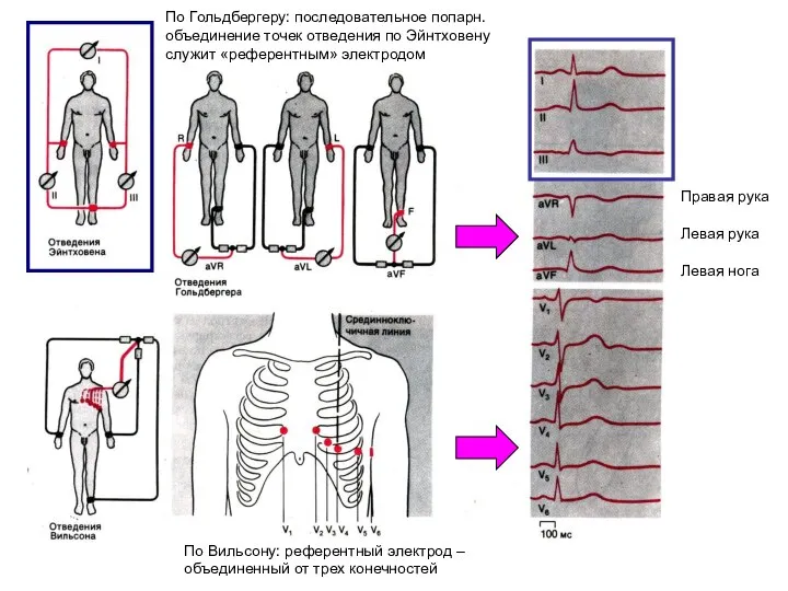 По Вильсону: референтный электрод – объединенный от трех конечностей По Гольдбергеру: последовательное