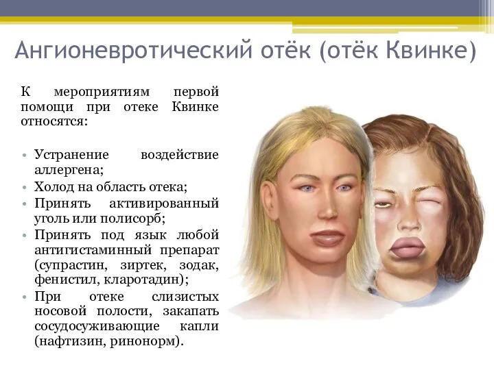 Ангионевротический отёк (отёк Квинке) К мероприятиям первой помощи при отеке Квинке относятся: