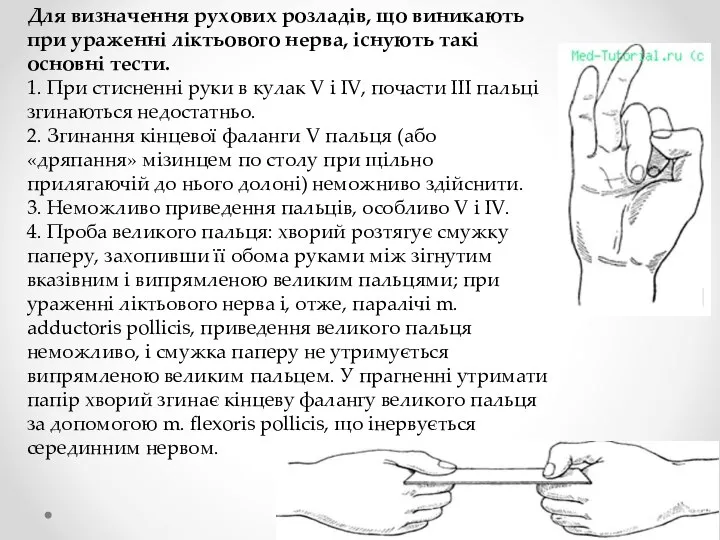 Для визначення рухових розладів, що виникають при ураженні ліктьового нерва, існують такі