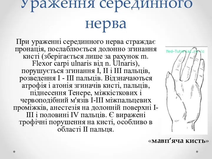 Ураження серединного нерва При ураженні серединного нерва страждає пронація, послаблюється долонно згинання