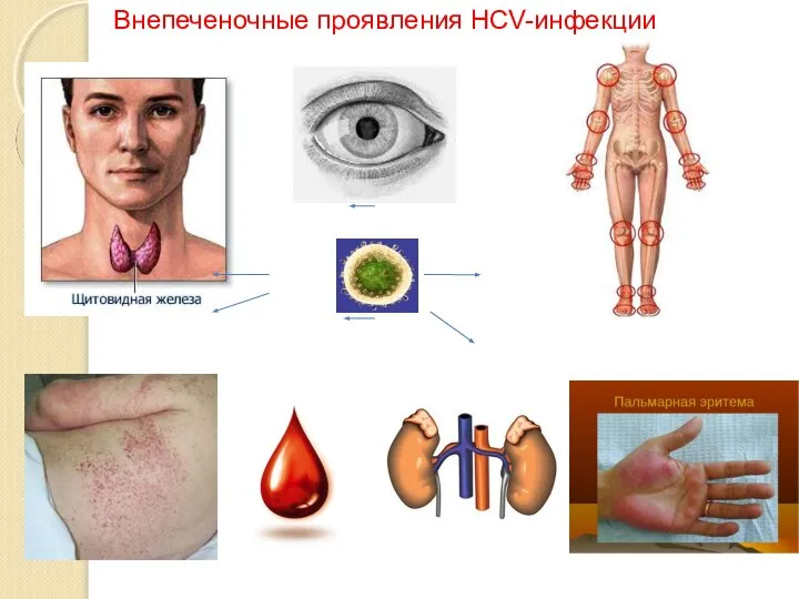 Внепеченочные проявления HCV-инфекции