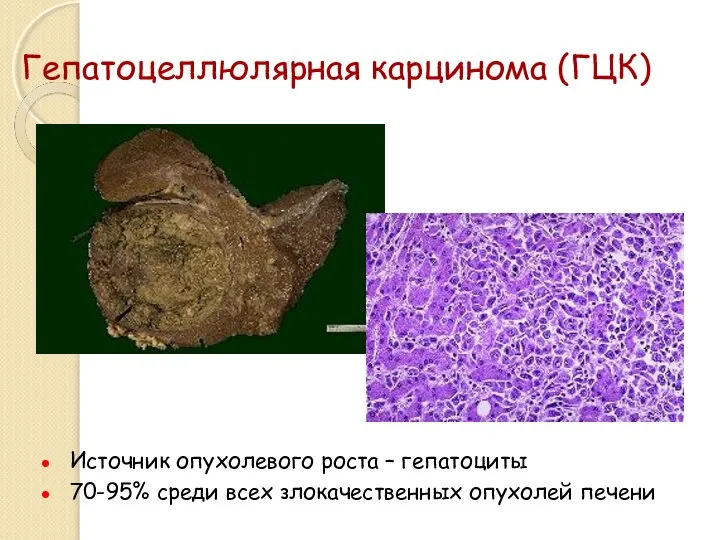 Гепатоцеллюлярная карцинома (ГЦК) Источник опухолевого роста – гепатоциты 70-95% среди всех злокачественных опухолей печени