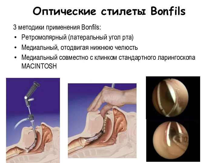 Оптические стилеты Bonfils 3 методики применения Bonfils: Ретромолярный (латеральный угол рта) Медиальный,