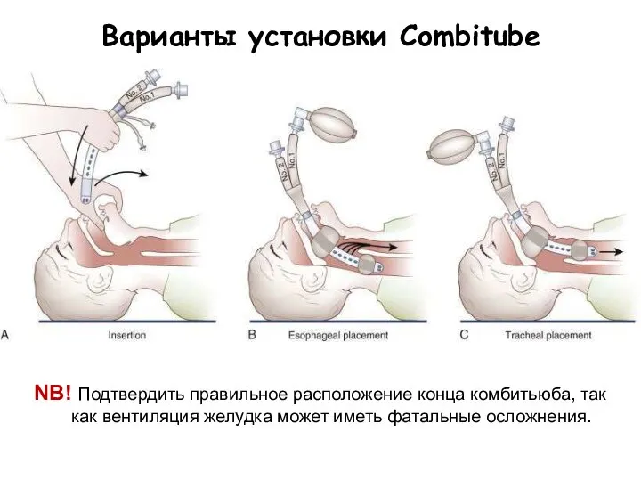 Варианты установки Combitube NB! Подтвердить правильное расположение конца комбитьюба, так как вентиляция