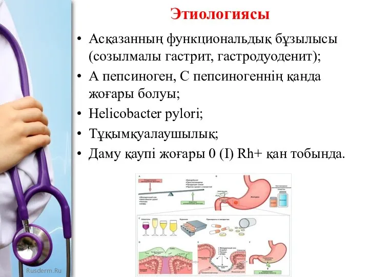 Этиологиясы Асқазанның функциональдық бұзылысы (созылмалы гастрит, гастродуоденит); А пепсиноген, С пепсиногеннің қанда