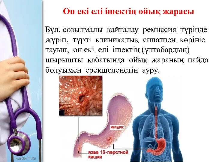 Он екі елі ішектің ойық жарасы Бұл, созылмалы қайталау ремиссия түрінде жүріп,