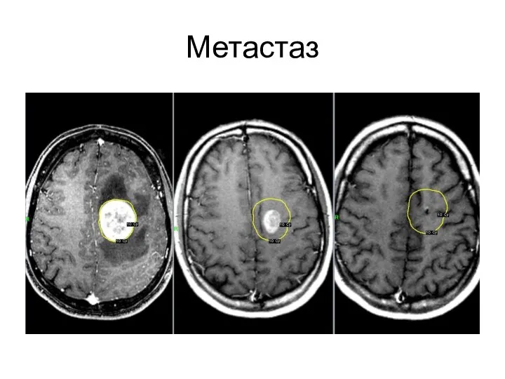 Метастаз