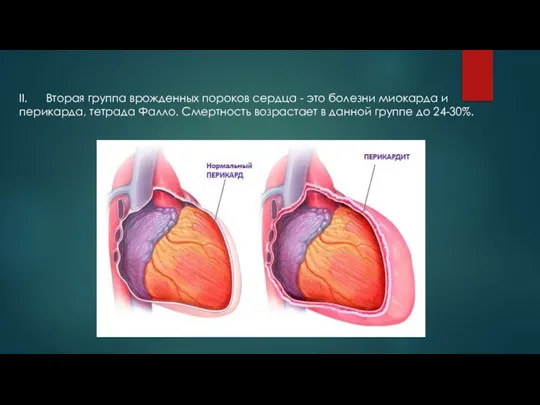II. Вторая группа врожденных пороков сердца - это болезни миокарда и перикарда,