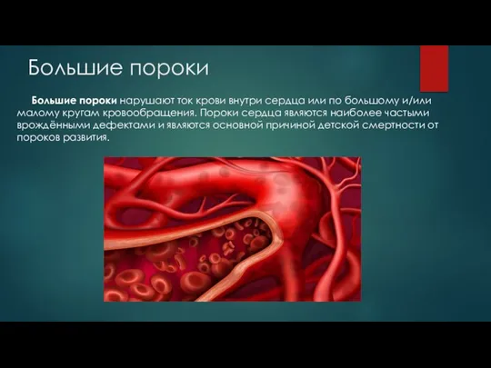 Большие пороки Большие пороки нарушают ток крови внутри сердца или по большому