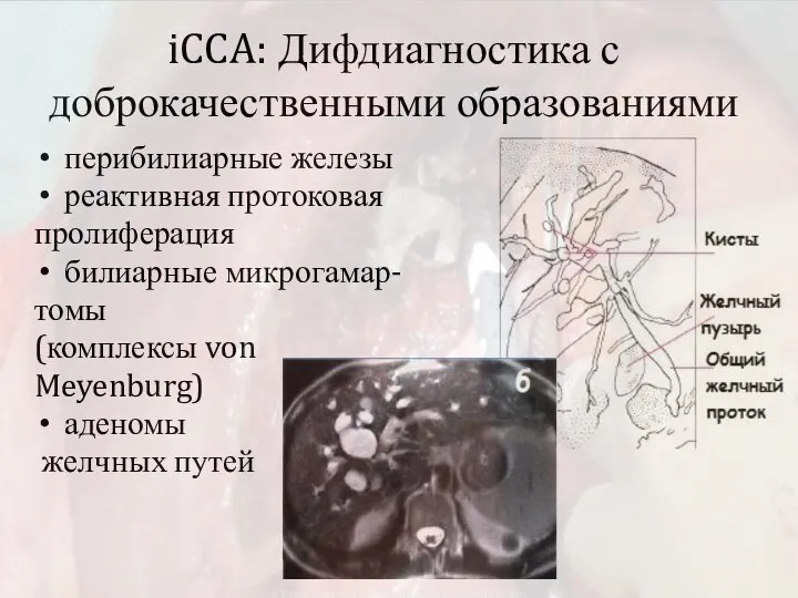 iCCA: Дифдиагностика с доброкачественными образованиями перибилиарные железы реактивная протоковая пролиферация билиарные микрогамар-