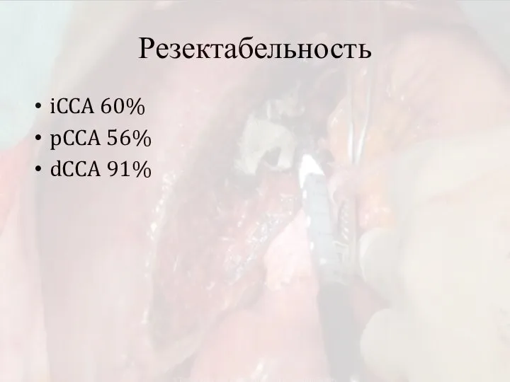 Резектабельность iCCA 60% pCCA 56% dCCA 91%