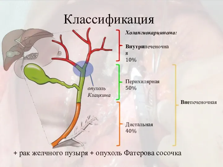 Классификация Внутрипеченочная 10% Перихилярная 50% Дистальная 40% Холангиокарцинома: Внепеченочная опухоль Клацкина +