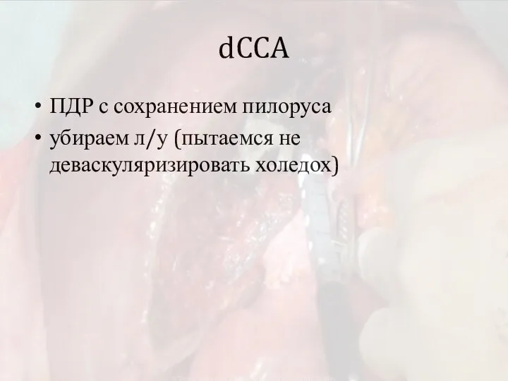 dCCA ПДР с сохранением пилоруса убираем л/у (пытаемся не деваскуляризировать холедох)