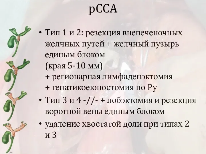 pCCA Тип 1 и 2: резекция внепеченочных желчных путей + желчный пузырь