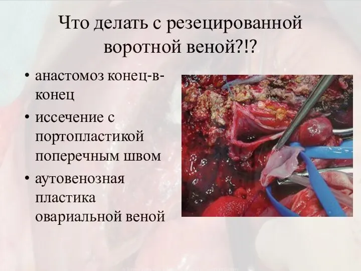 Что делать с резецированной воротной веной?!? анастомоз конец-в-конец иссечение с портопластикой поперечным