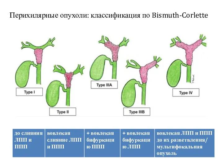 Перихилярные опухоли: классификация по Bismuth-Corlette