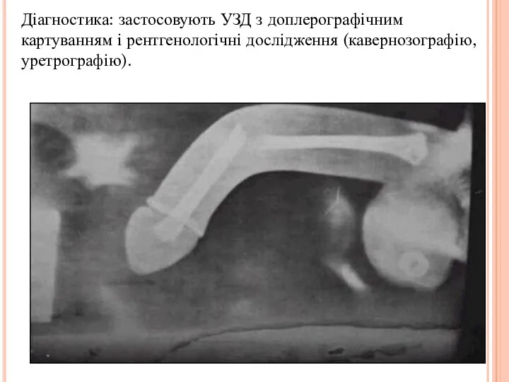 Діагностика: застосовують УЗД з доплерографічним картуванням і рентгенологічні дослідження (кавернозографію, уретрографію).