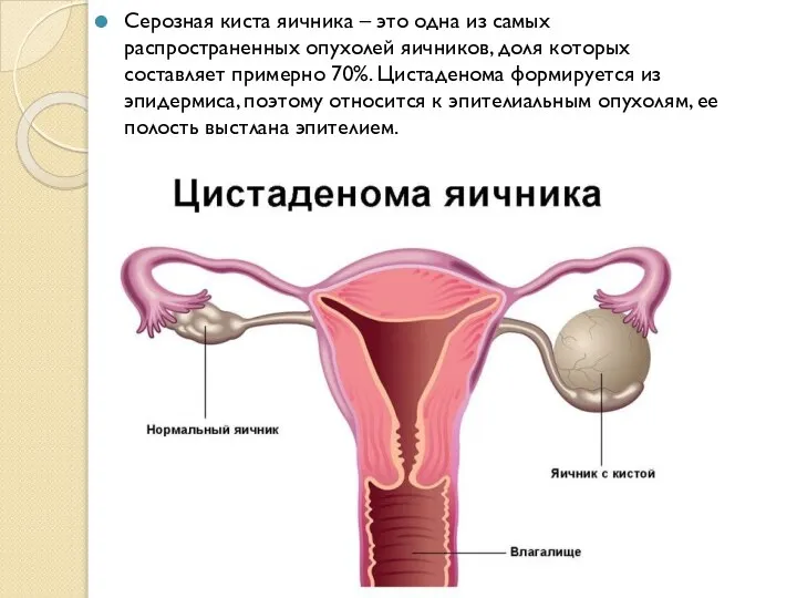 Серозная киста яичника – это одна из самых распространенных опухолей яичников, доля