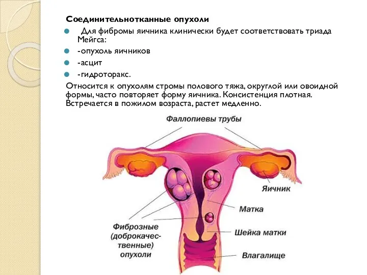 Соединительнотканные опухоли Для фибромы яичника клинически будет соответствовать триада Мейгса: - опухоль