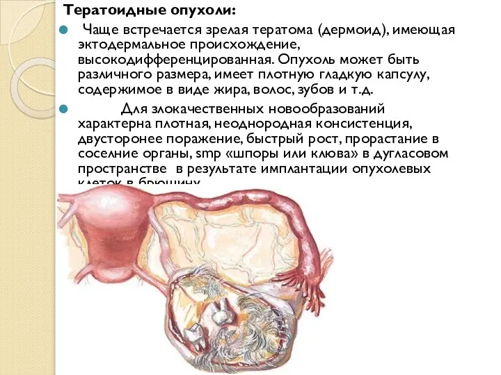 Тератоидные опухоли: Чаще встречается зрелая тератома (дермоид), имеющая эктодермальное происхождение, высокодифференцированная. Опухоль