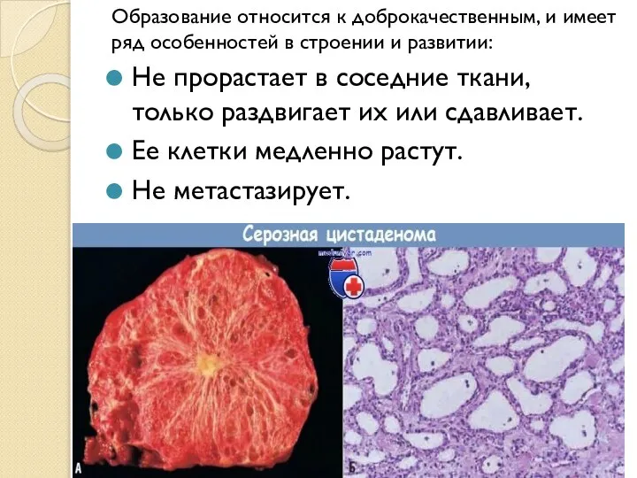 Образование относится к доброкачественным, и имеет ряд особенностей в строении и развитии: