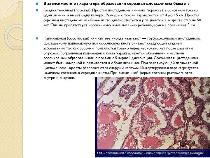В зависимости от характера образования серозная цистаденома бывает: Гладкостеночная (простая). Простая цистаденома