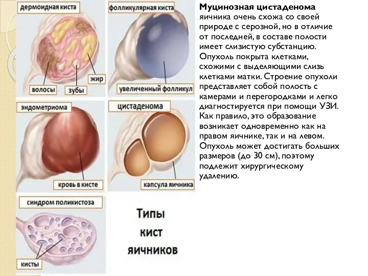 Муцинозная цистаденома яичника очень схожа со своей природе с серозной, но в
