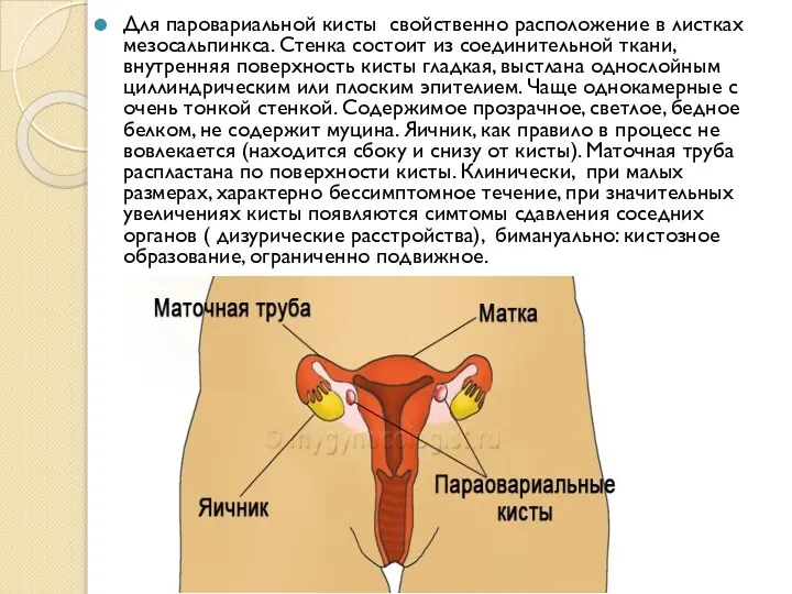 Для паровариальной кисты свойственно расположение в листках мезосальпинкса. Стенка состоит из соединительной