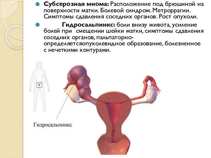 Субсерозная миома: Расположение под брюшиной на поверхности матки. Болевой синдром. Метроррагии. Симптомы