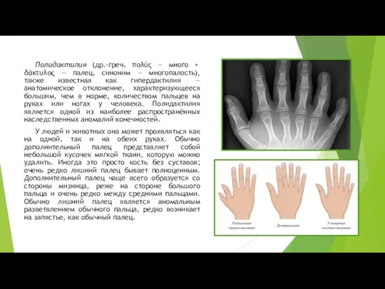 Полидактилия (др.-греч. πολύς — много + δάκτυλος — палец, синоним — многопалость),