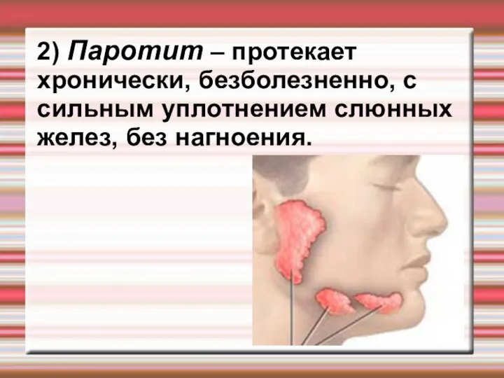 2) Паротит – протекает хронически, безболезненно, с сильным уплотнением слюнных желез, без нагноения.