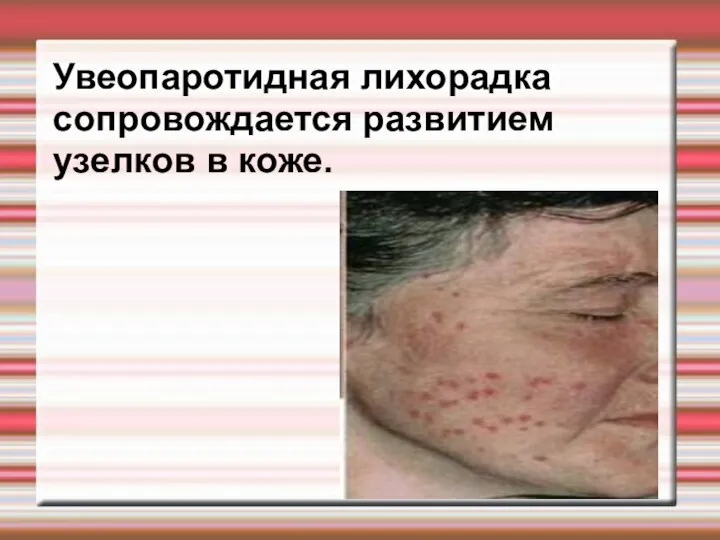 Увеопаротидная лихорадка сопровождается развитием узелков в коже.