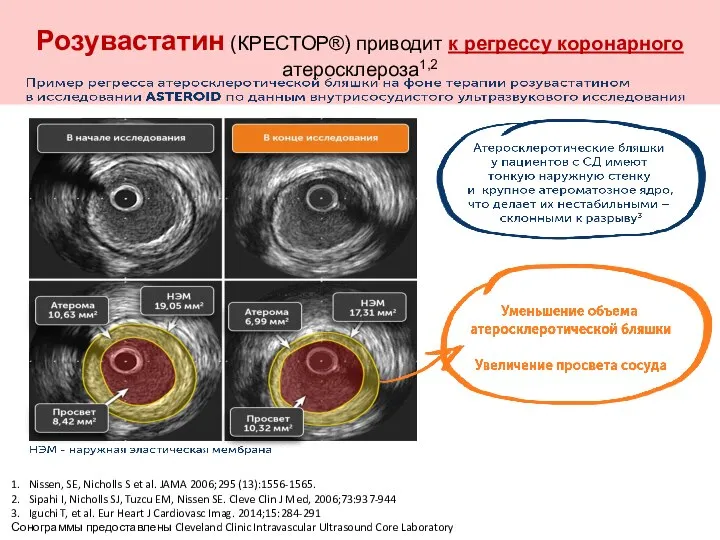 Розувастатин (КРЕСТОР®) приводит к регрессу коронарного атеросклероза1,2 1. Nissen, SE, Nicholls S