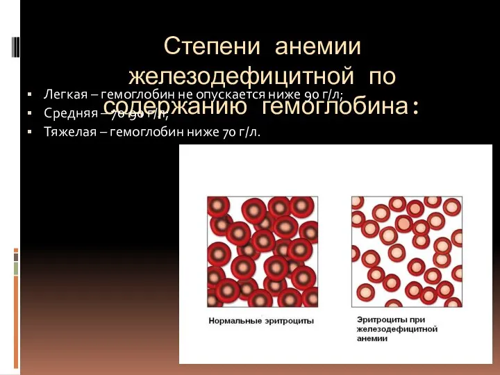 Степени анемии железодефицитной по содержанию гемоглобина: Легкая – гемоглобин не опускается ниже