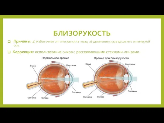 БЛИЗОРУКОСТЬ Причины: 1) избыточная оптическая сила глаза, 2) удлинение глаза вдоль его