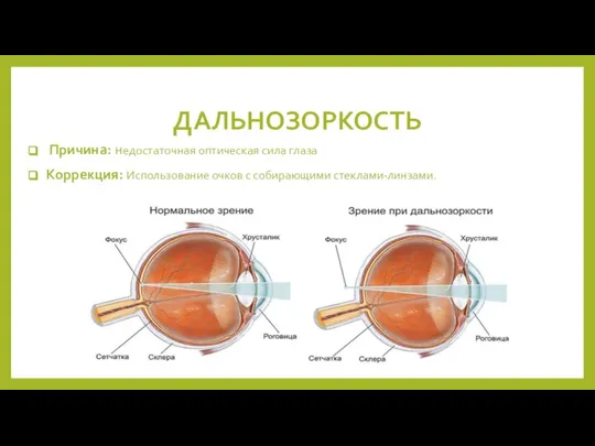 ДАЛЬНОЗОРКОСТЬ Причина: недостаточная оптическая сила глаза Коррекция: Использование очков с собирающими стеклами-линзами.
