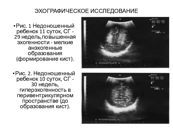 ЭХОГРАФИЧЕСКОЕ ИССЛЕДОВАНИЕ Рис. 1 Недоношенный ребенок 11 суток, СГ - 29 недель,повышенная